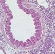 Inflammation pulmonaire Inflammation pulmonaire