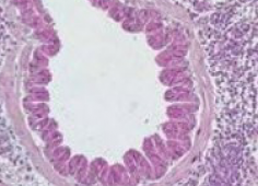 Inflammation pulmonaire Inflammation pulmonaire
