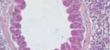 Inflammation pulmonaire